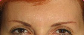 Морщины после инъекции Botox