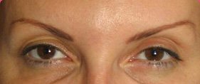 Botox убрал мимические морщины