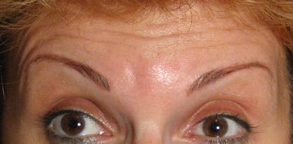 Botox ��������� (���) ����