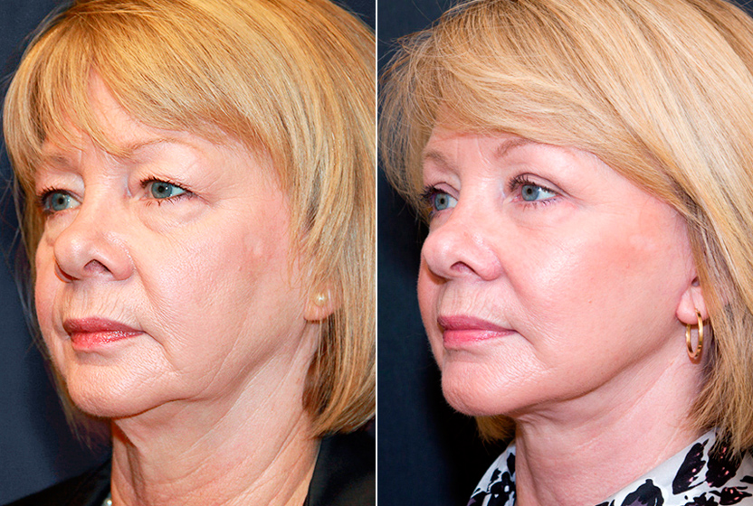 Контурная пластика лица: фото до и после