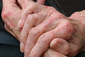 Экзема на пальцах рук: основные симптомы