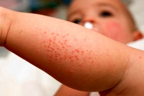 Лечение аллергической сыпи у детей