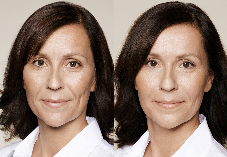 Контурная пластика лица: фото до и после