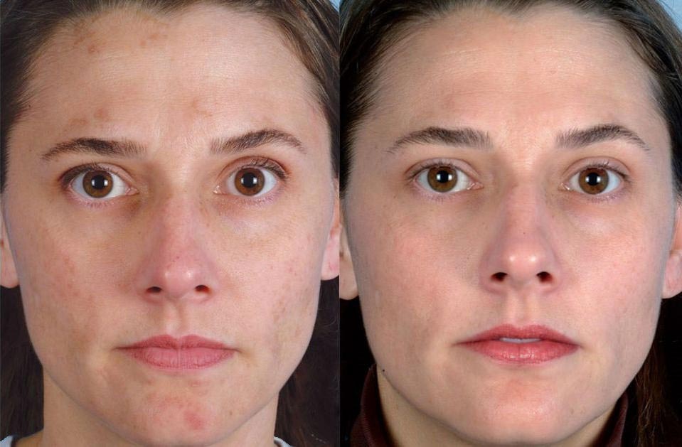 Криотерапия: фото до и после