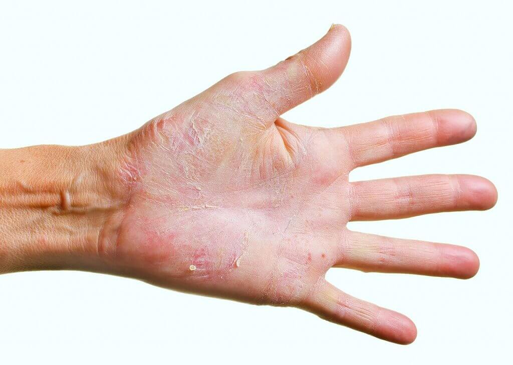 Лечение грибковых заболеваний кожи